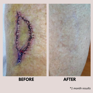 SCAR CARE TREATMENT