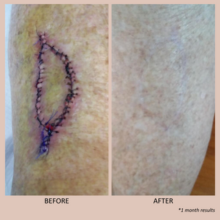 SCAR CARE TREATMENT