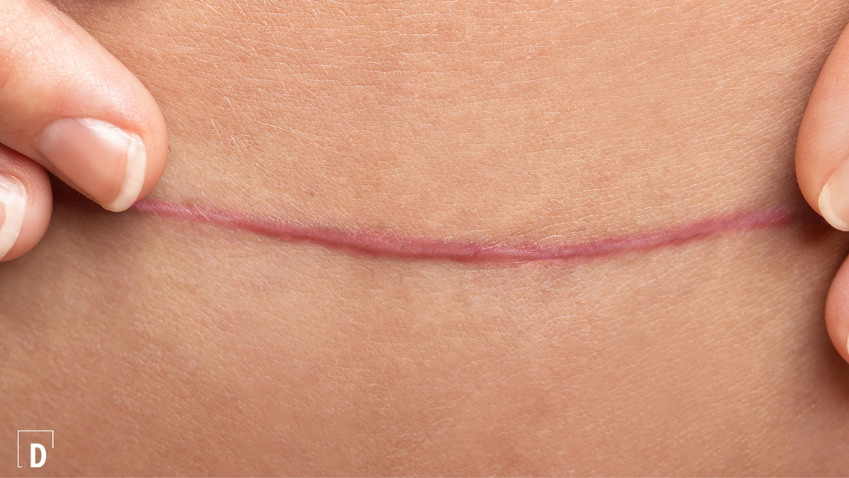 scar care basics: 3 steps to support skin healing | dermphase – DermPhase
