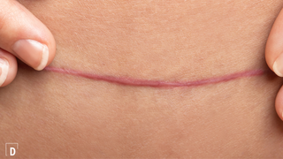 how to reduce the appearance of scars: 3 skincare tips for healing skin