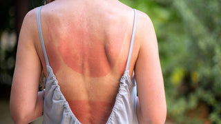 what happens to your skin when it gets burnt